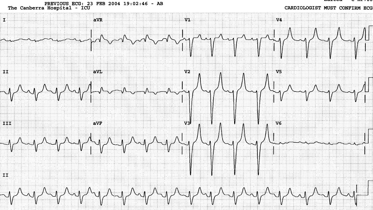 31 year old man with unusually severe IgA nephropathy and congestive cardiomyopathy