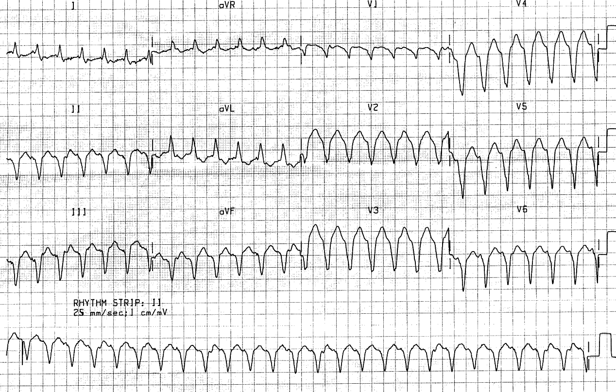 The preceding VT, showing slow S descent in LBBB-like complex of V1. The negative concordance is less important, diagnostically; LAD is worthless.