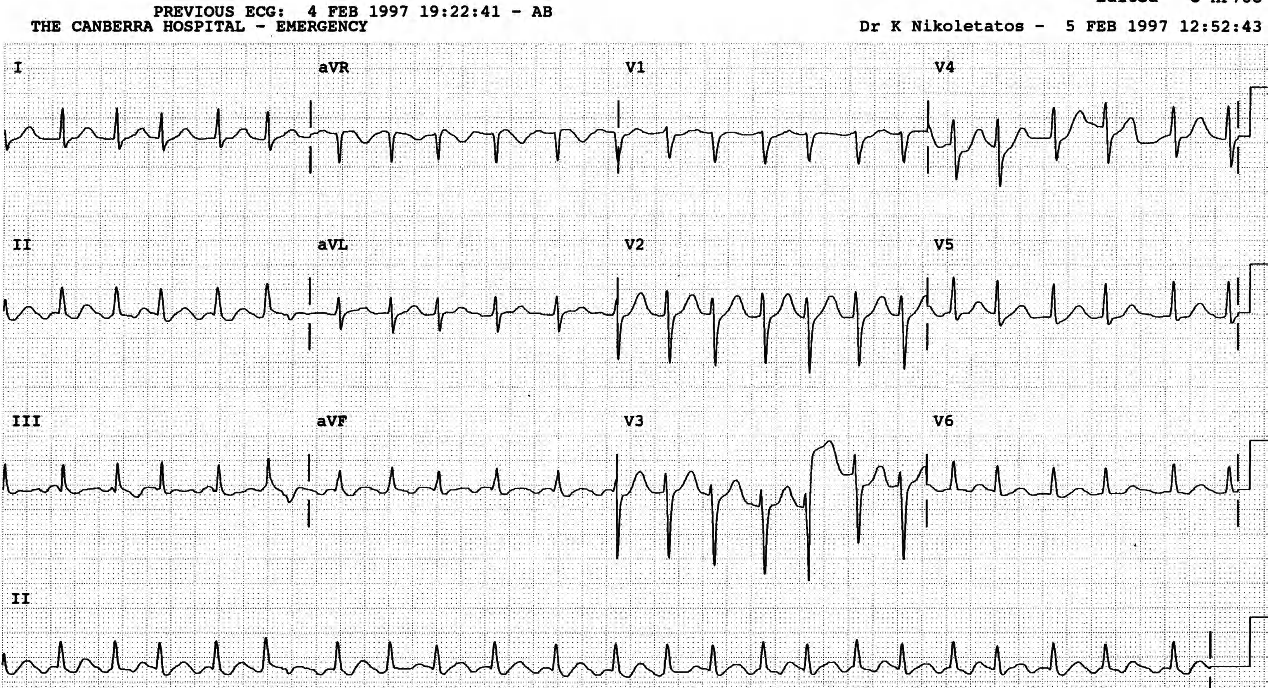 Post-sotalol flutter with 2:1 and variable block. 