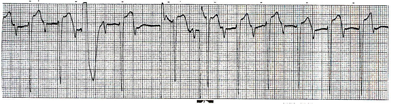 Postponed compensatory pause. What precedes it is a combination of type 1 AVB and concealed retrograde conduction â doubly concealed, as it were, in this case. 