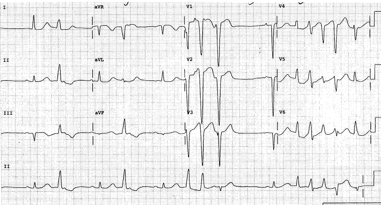 72 year old lady on sotalol