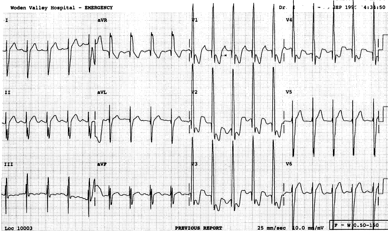 13 year old boy awaiting cardiac transplantation for
severe heart failure. He was born with transposition of the great
vessels, treated initially by septotomy and later by Mustard procedure;
a permanent pacemaker had been implanted. The cardiologistâs report is
preserved above the trace.