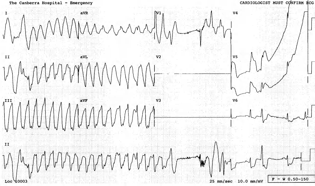 36 year old man in shock, narrowly missing being shocked. Two potential causes of shock are evident. 