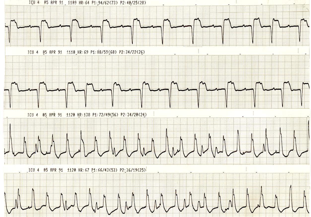 Tachycardia in a progressively hypotensive patient with pulmonary hypertension (v. pressure readouts on the strips; the lead was changed after the second strip). What is the evidence that the tachycardia was responsible for the fall in systemic pressure? 