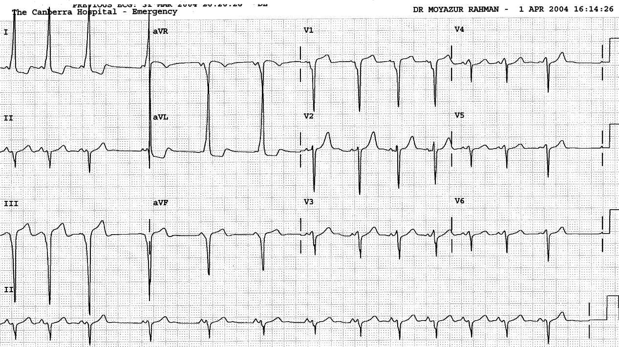 11 year old boy transferred from a country hospital after an episode of narrow-complex tachycardia 280/min.