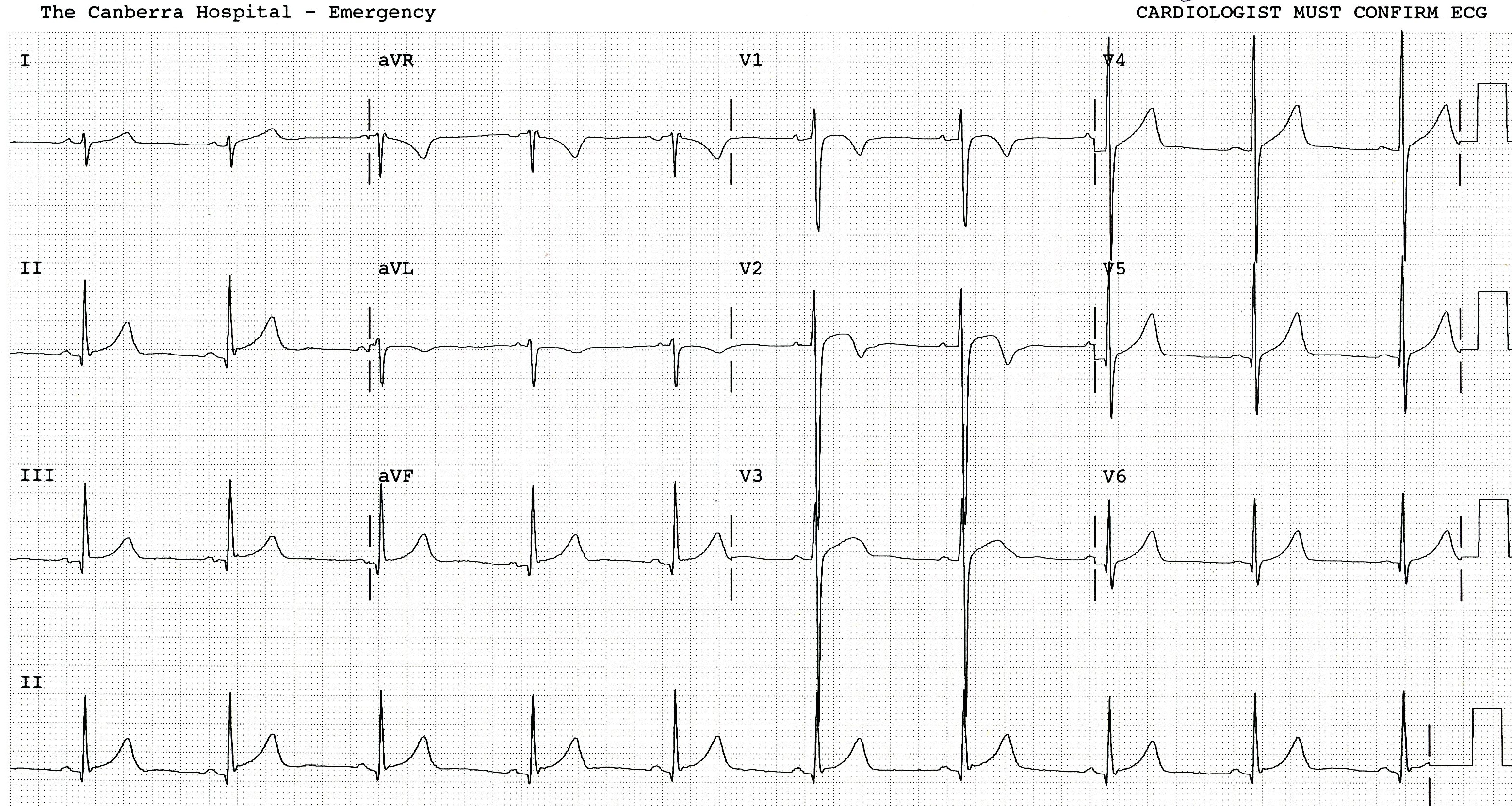 20 year old with foreign body in his eye, thought (mistakenly) to require surgery and general anaesthesia. It never came to that, but a 12-lead ECG was secured.