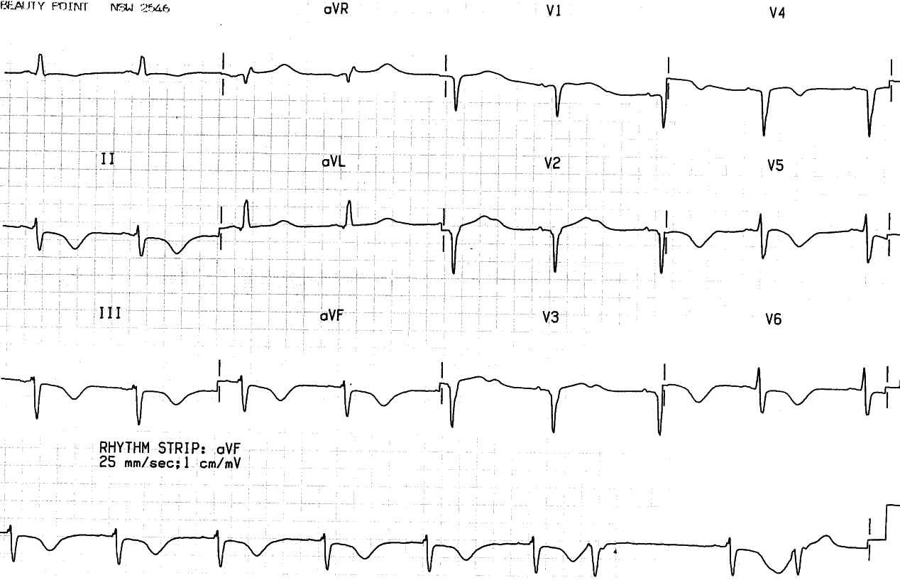 72 year old lady with congestive cardiomyopathy, recently started on sotalol for VT