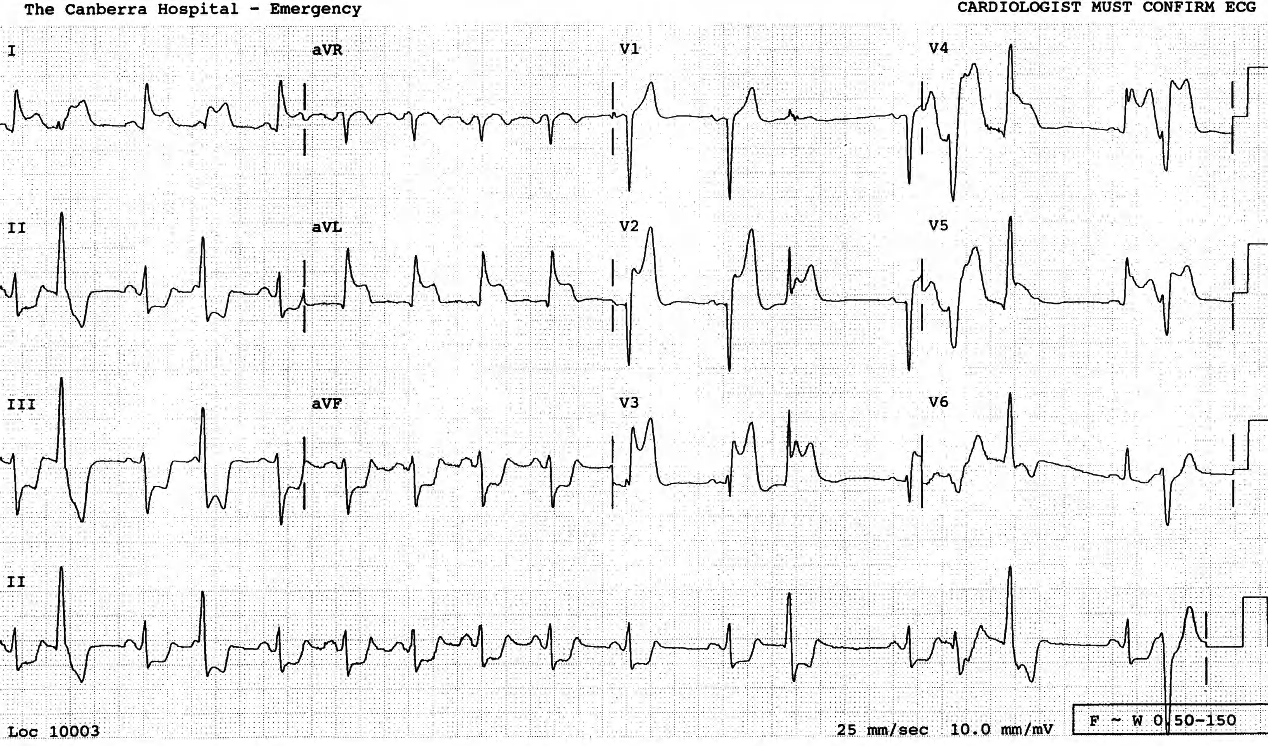 Sinus arrhythmia with frequent ectopics; the latter are rather narrow, but probably ventricular. There is an extensive acute anterior infarction. 