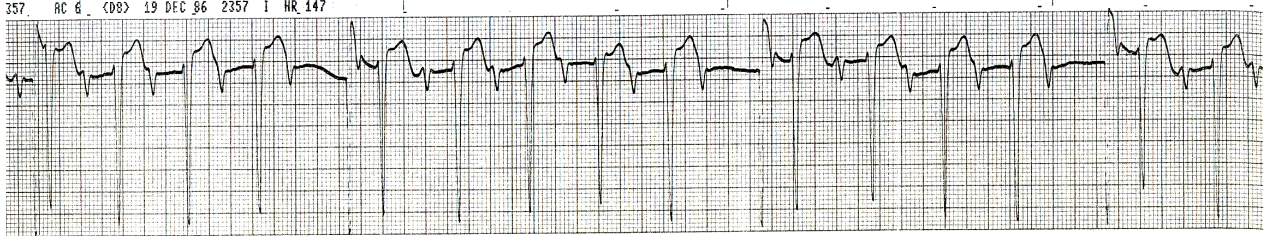 The lower strip shows simple   Wenckebach sequences, with pauses decorated with non-capturing pacing   spikes. 