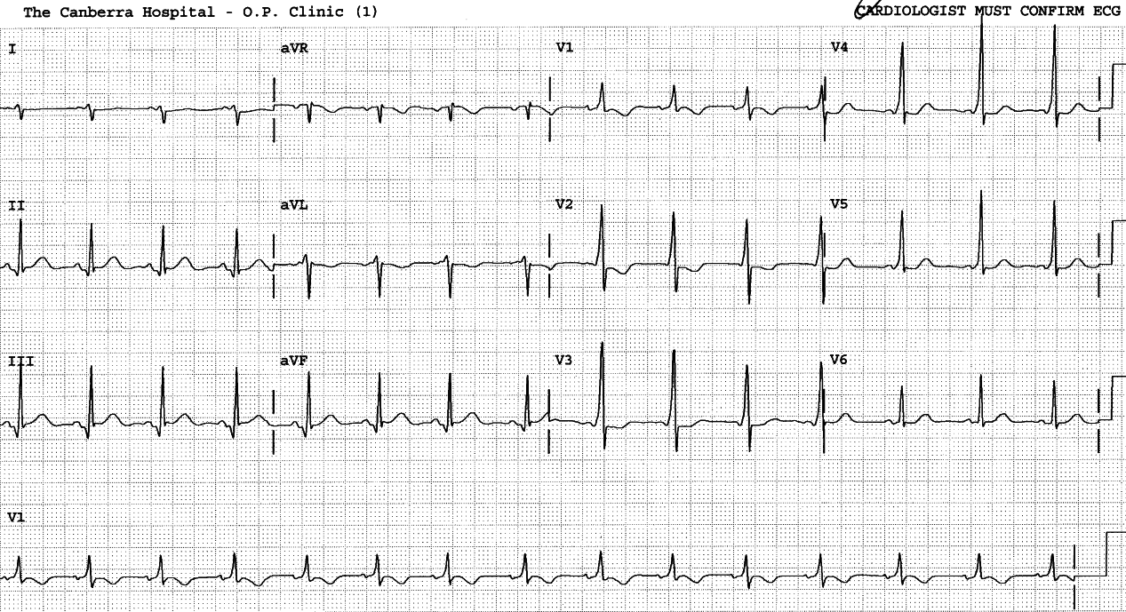 Spastic 17 year old boy with no cardiac symptoms or history.