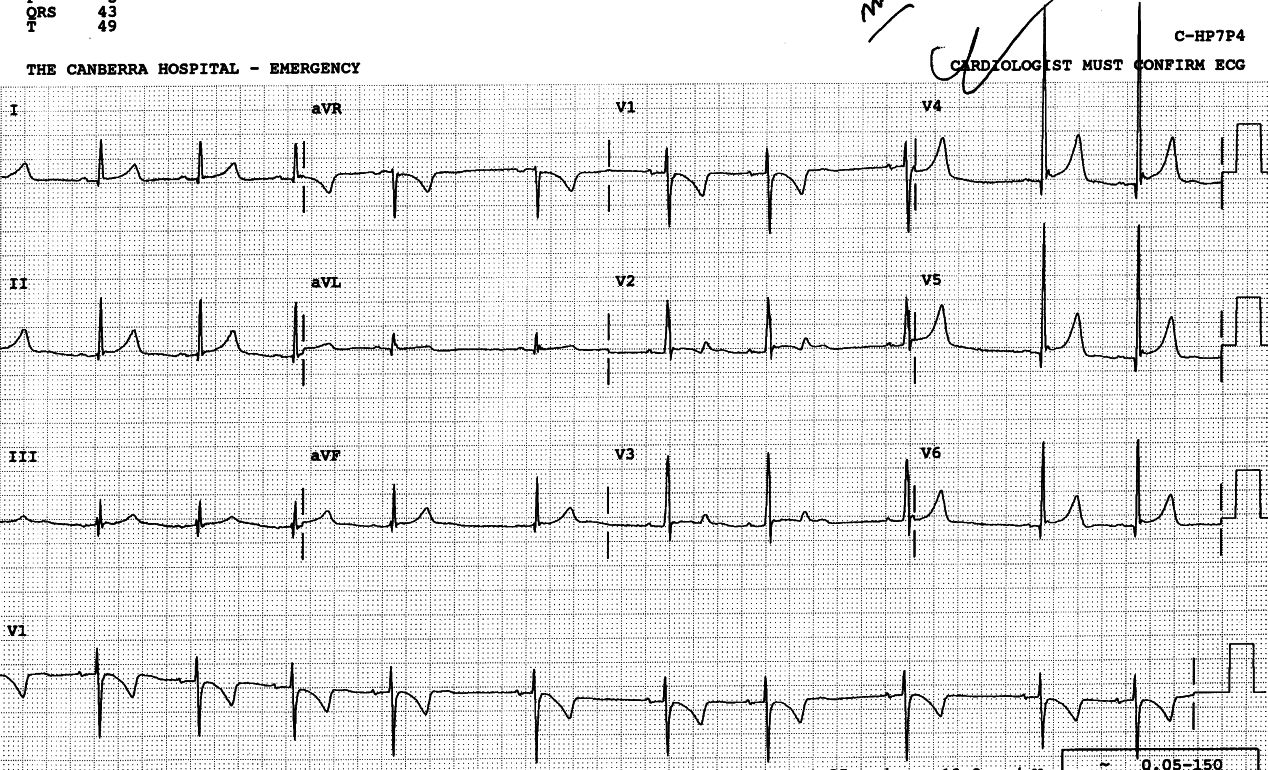 Early repolarisation in the anterolateral leads. The terminal notch of the QRS is called J notch, like J wave in hypothermia. High voltage is characteristic of early repolarisation.