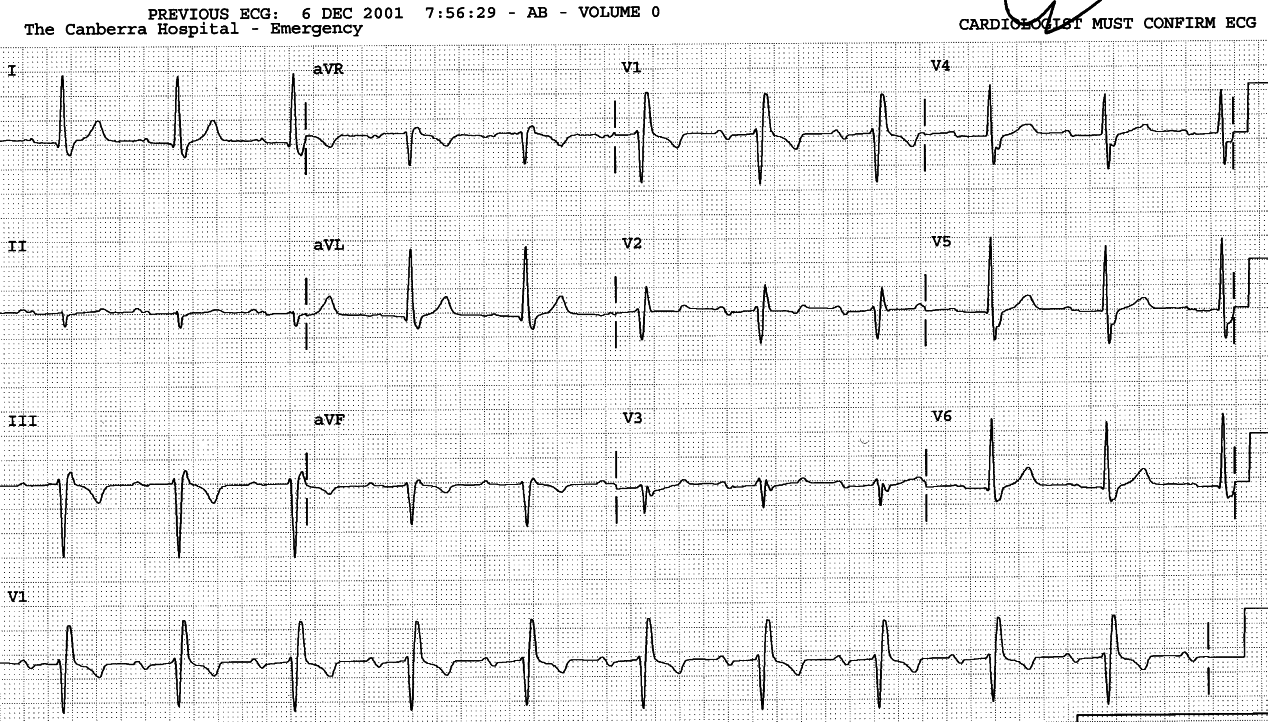 Asymptomatic 73 year old man on verapamil and monopril