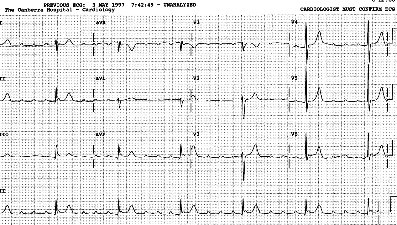 5:1 AVB in an otherwise normal ECG.