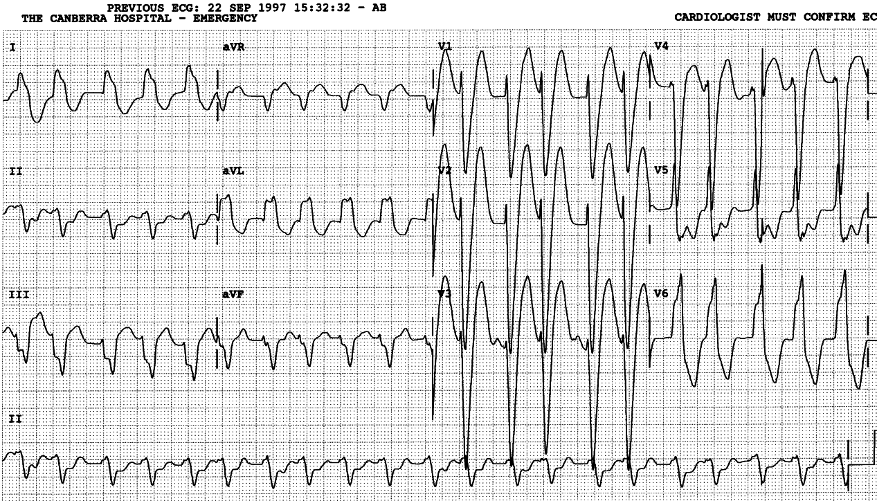 Broader LBBB, from another patient, in AF with rapid response.