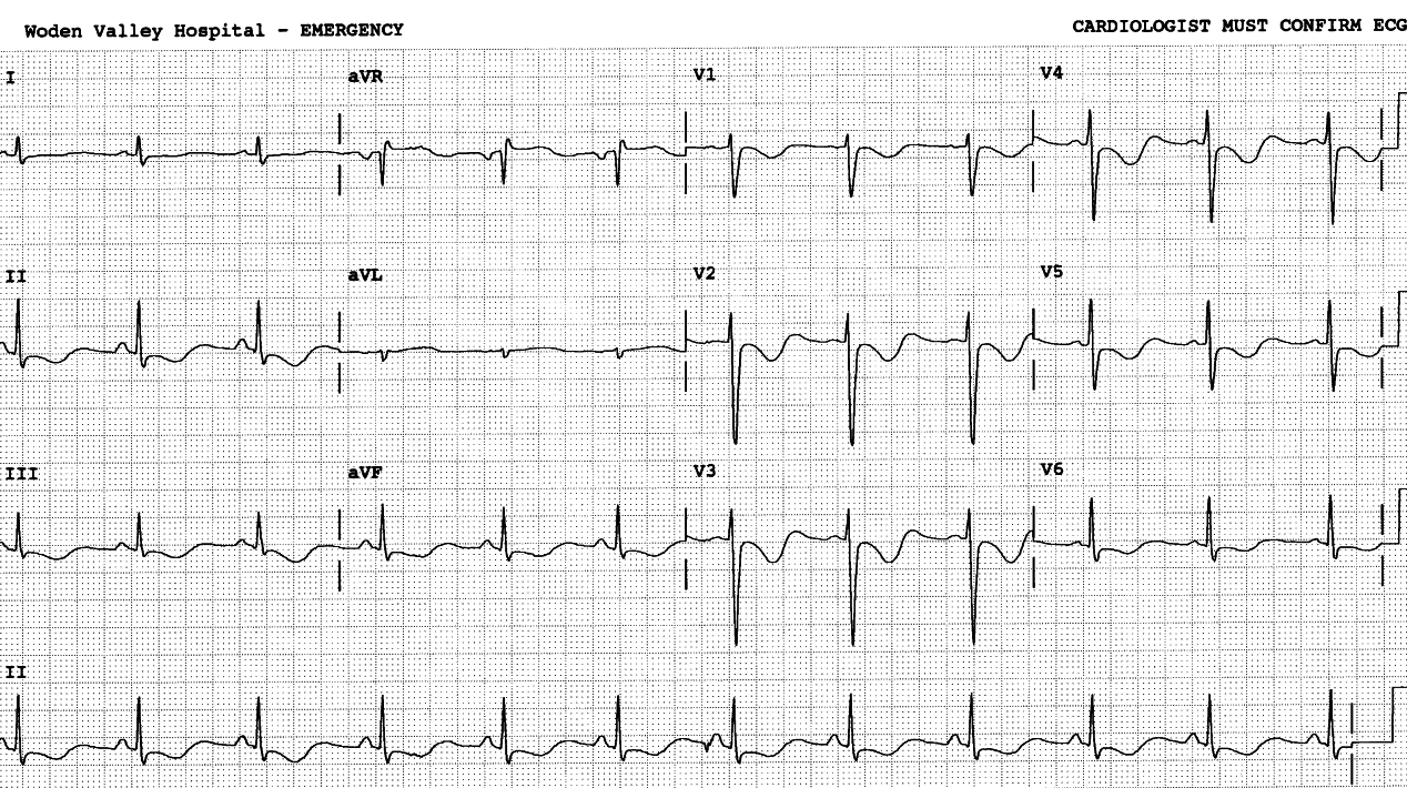 21 year old lady with episodic bulimia and vomiting