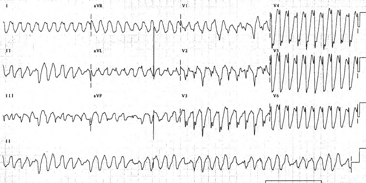 âPounding chestâ and nausea in a previously healthy 25 year old man. 