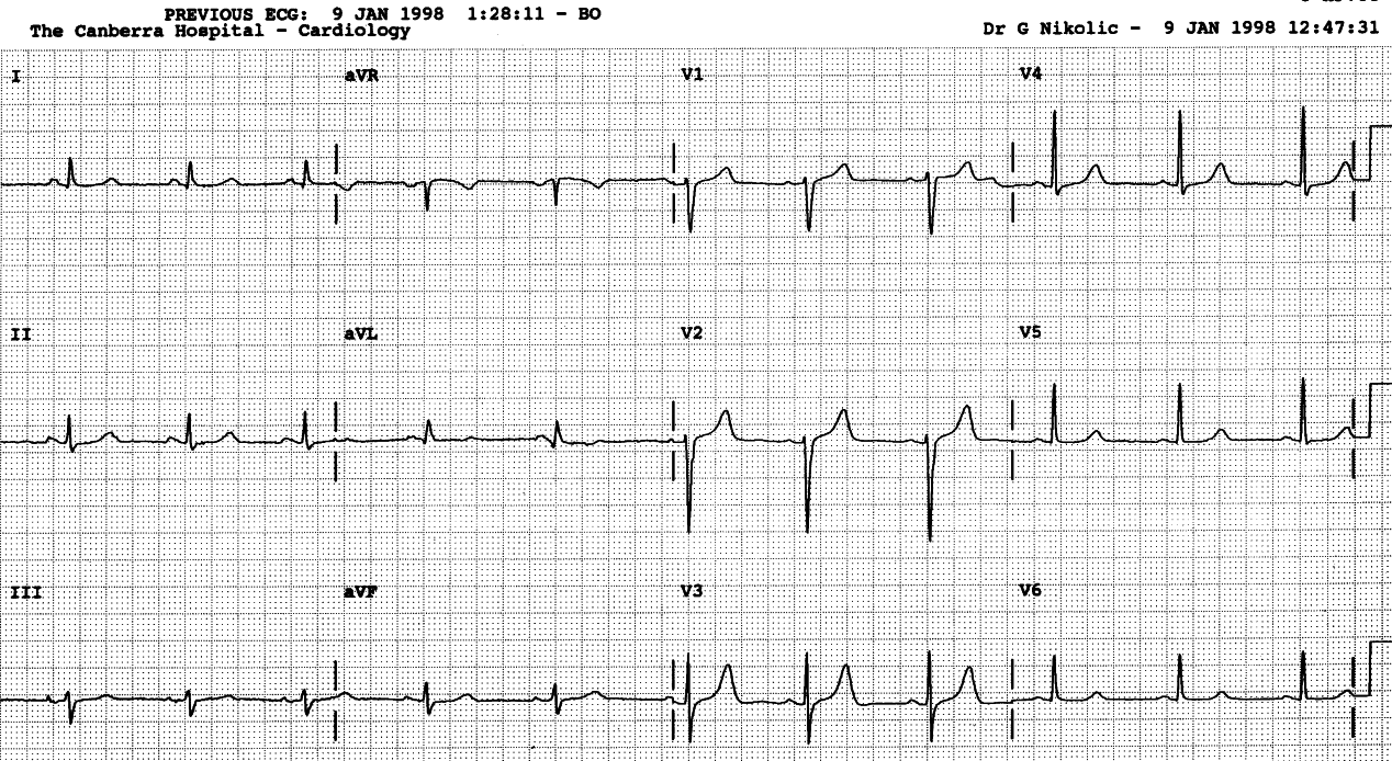 Stage of illusion on the second day of anterior infarction.