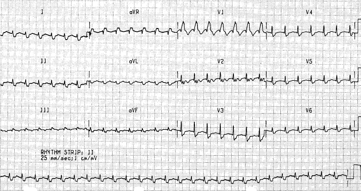 74 year old lady following antrectomy. Her BP is 60 mmHg, with PA pressure 30/18 and PCW 7 mmHg