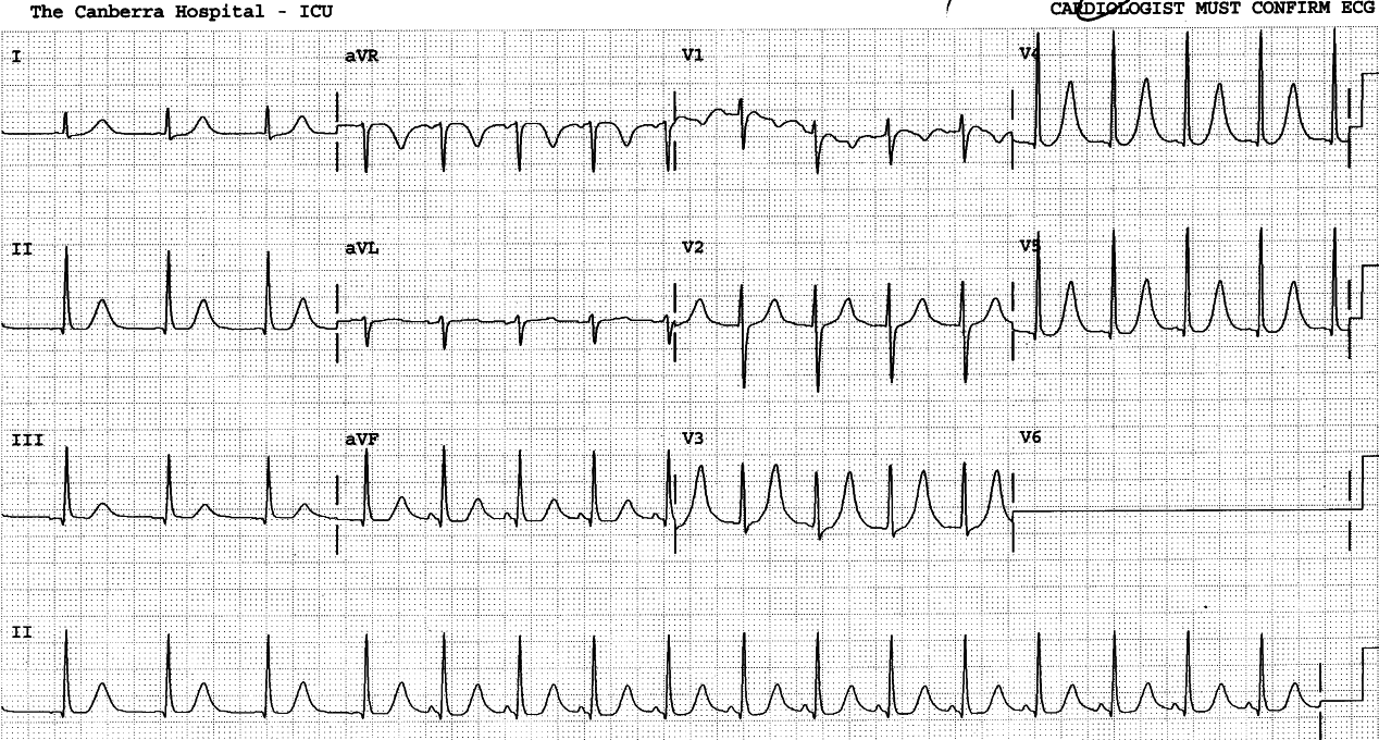 More peaked T waves with normal potassium