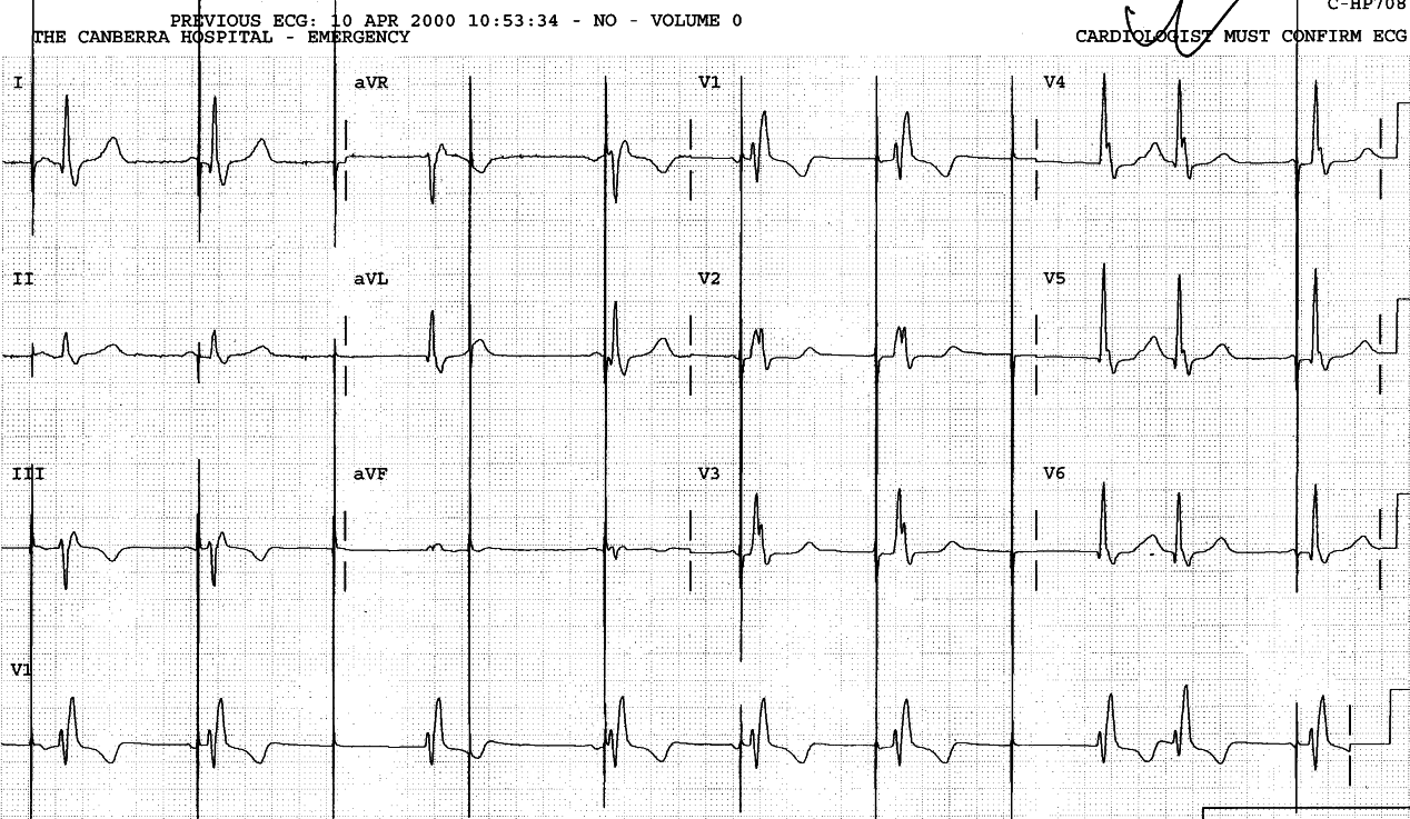 Sinus rhythm and arrests, with junctional escapes and
failed ventricular pacemaker. The RBBB is the same as above in Fig
114.