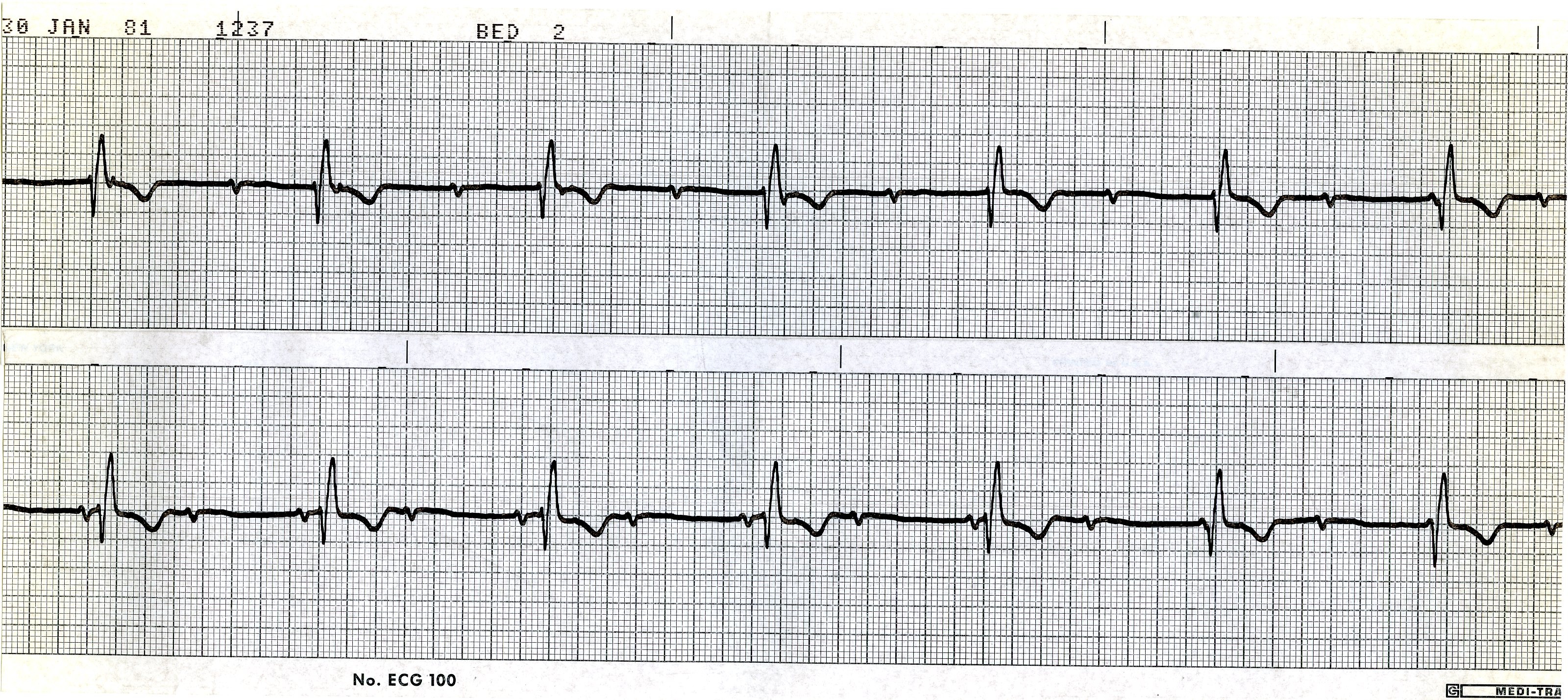 In the top strip extra P waves lurk from the first and     the last QRS most obviously. The in-between could pass for a Wenckebach     sequence, exceptâ¦  