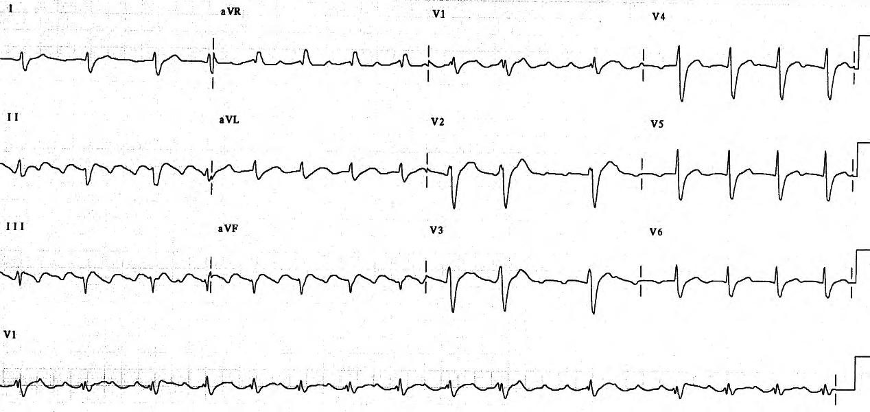 Atrial flutter seen after putative cardioversion by amiodarone. 