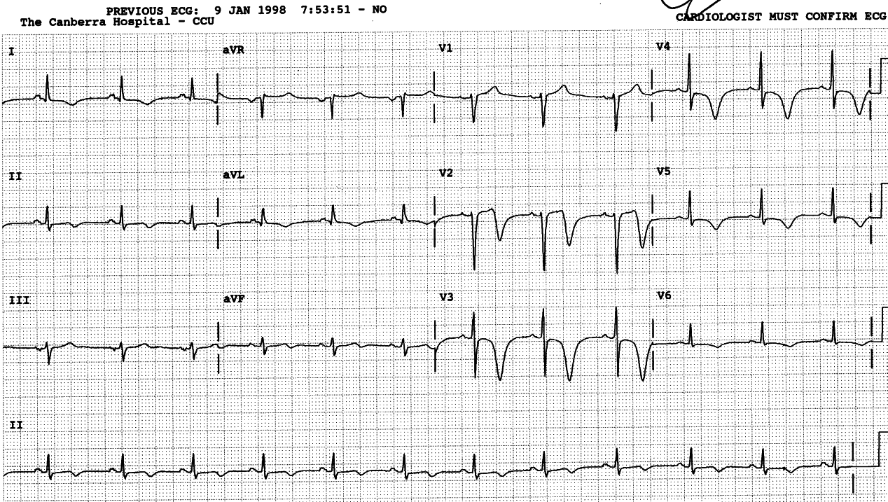 Same 41 year old (whose ECG normalised, Fig 96a) two days later, with more pain.