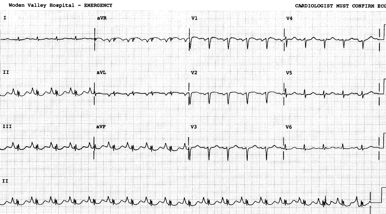 66 year old heavy smoker ventilated for decompensated COAD