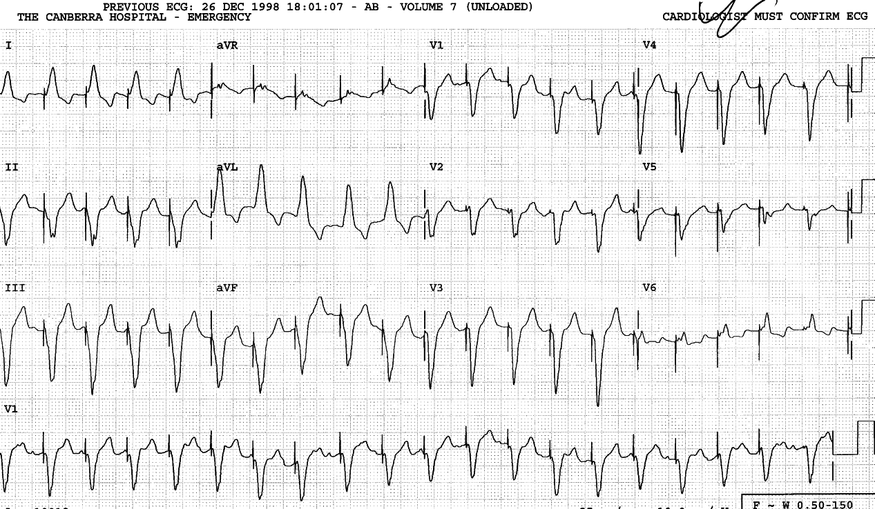 61 year old man with âracing heartâ feeling like his
previous episodes of AF. Sotalol, 40 mg IV, restored sequential AV
pacing at 60/min.