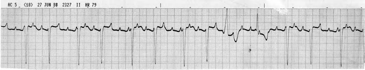 How many supraventricular complexes are replaced by the FLBs (funny-looking beats)? 