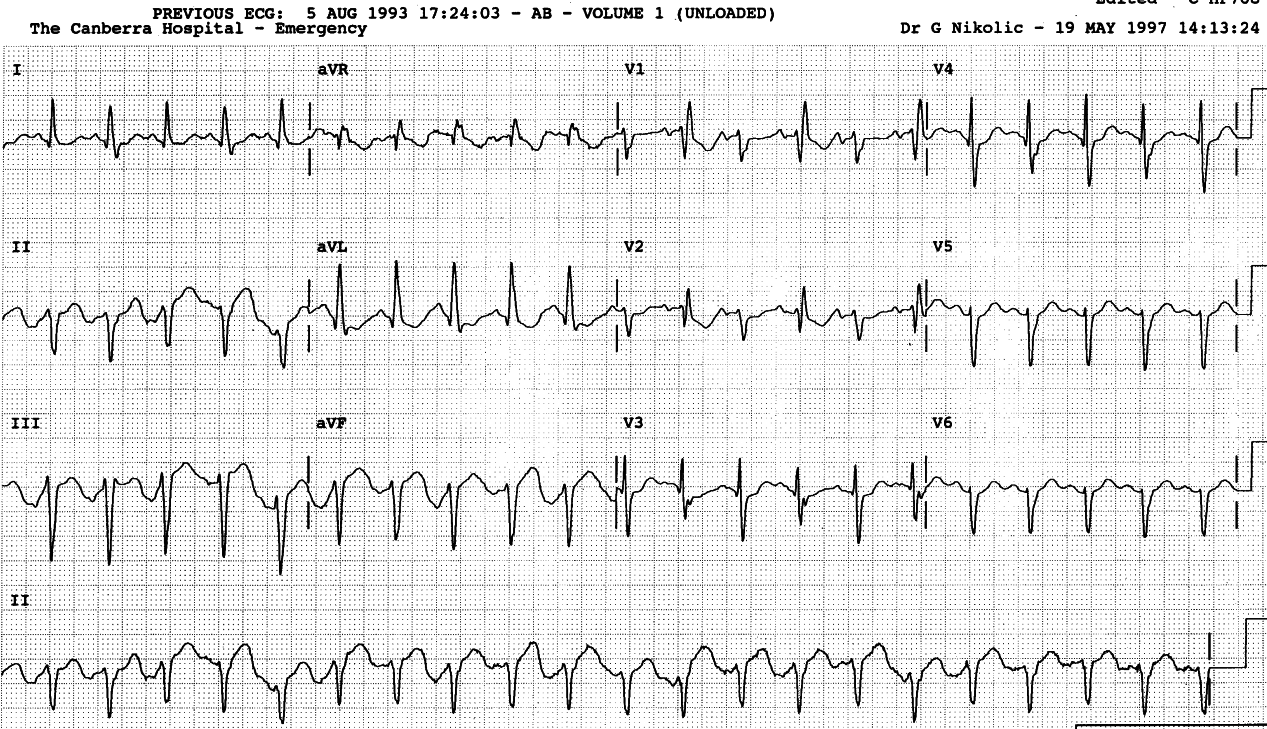 76 year old lady with asthma and chest infection.