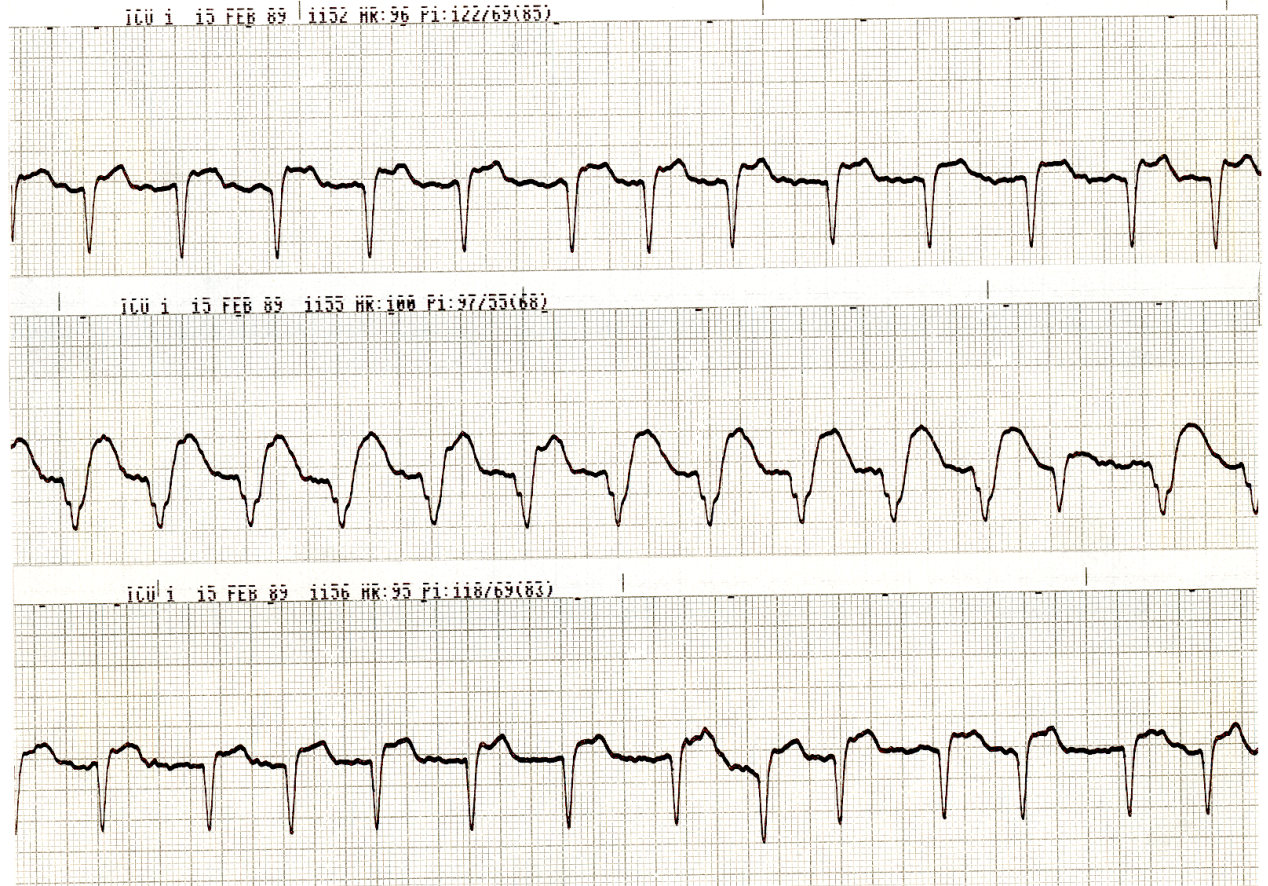 68 year old man with severe ischaemic cardiomyopathy and recurrent cardiac arrests. Ventricular pacing (only slightly above the native heart rate, to ensure capture) regularly produced a significant drop in his blood pressure. Why?