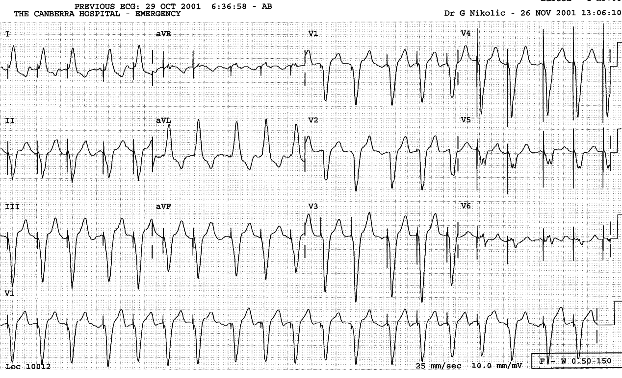 Recurrence og paced tachycardia.