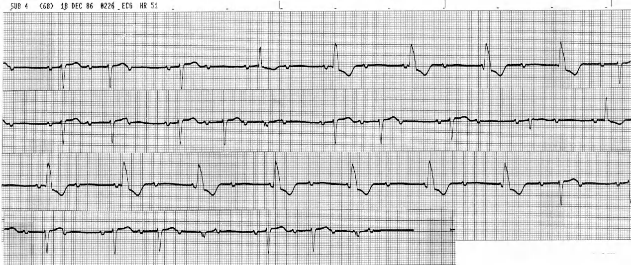 Digoxin-toxic 84 year old man. 