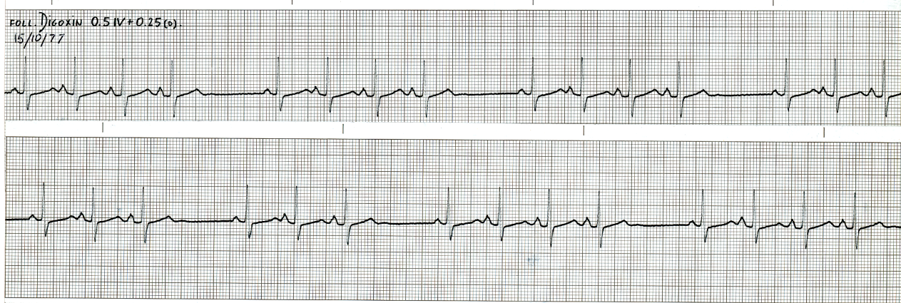 73 year old woman, digitalised for atrial fibrillation (Lead 2). 