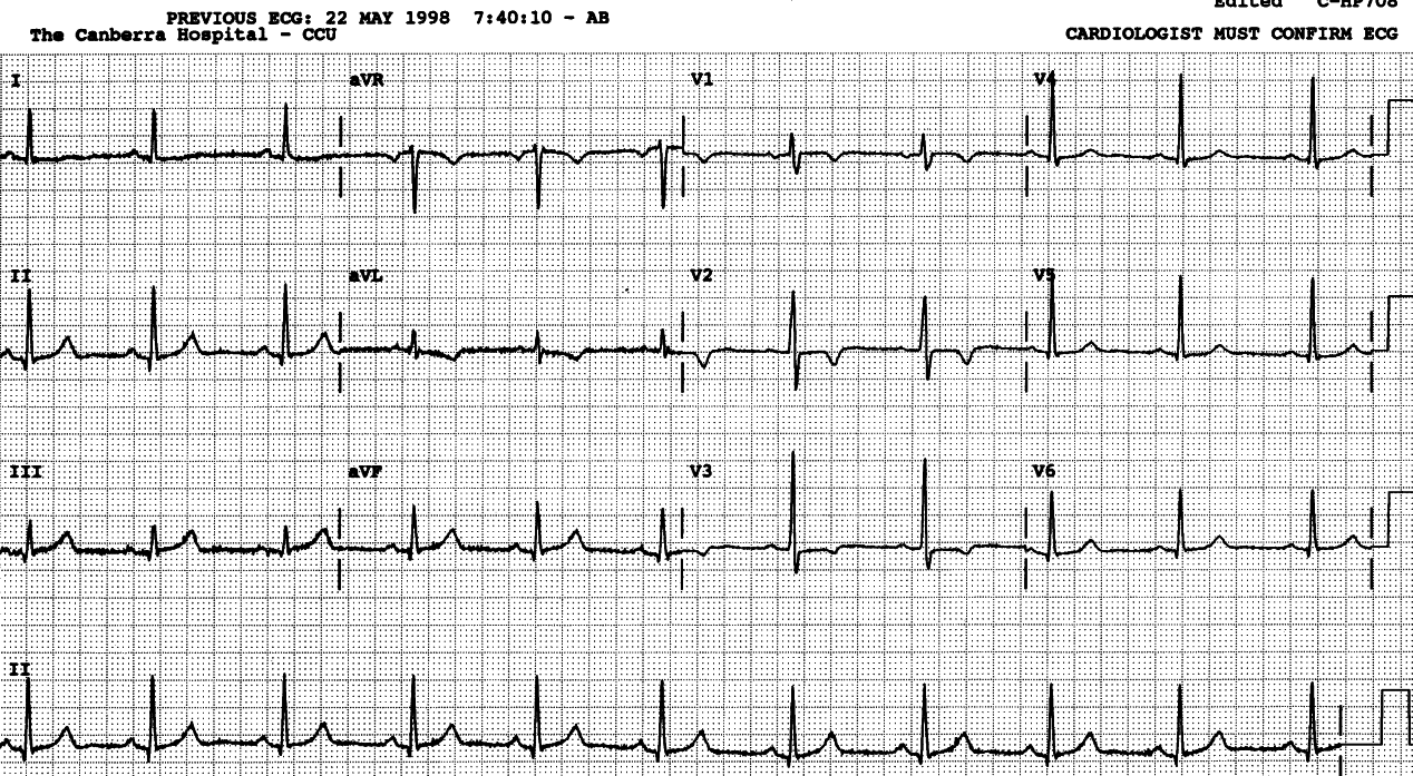 Wellensâ warning. The early transition seen here is a normal variant; T wave inversion in V2-3 (except in a juvenile) isnât.