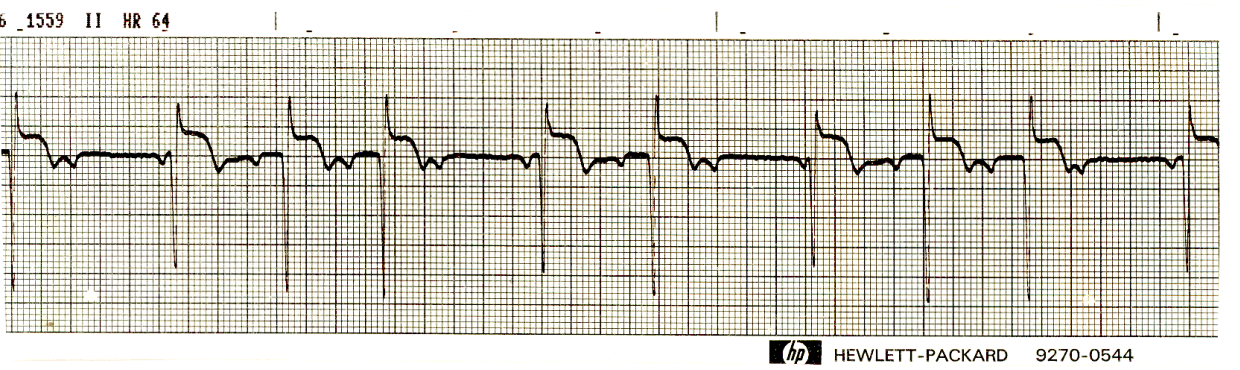 Shorter S waves in junctional escape beats prove that the     antecedent P waves are not conducted. The strip also shows some     escape-capture trigeminy (the term is not generally used, but I     like it). 