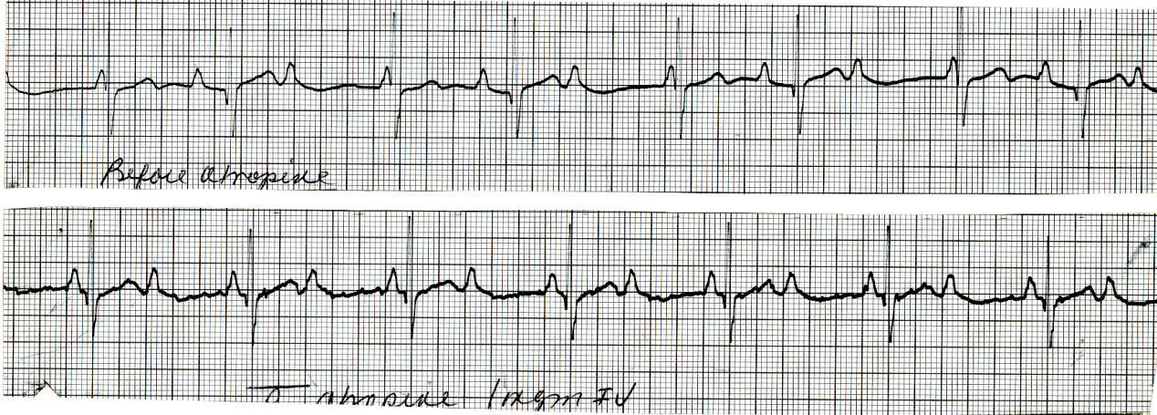 49 year old man four days after an acute inferior infarction, with progressive AV conduction impairment over the past 24 hours. A trial dose of 1 mg atropine was administered during the top strip. 