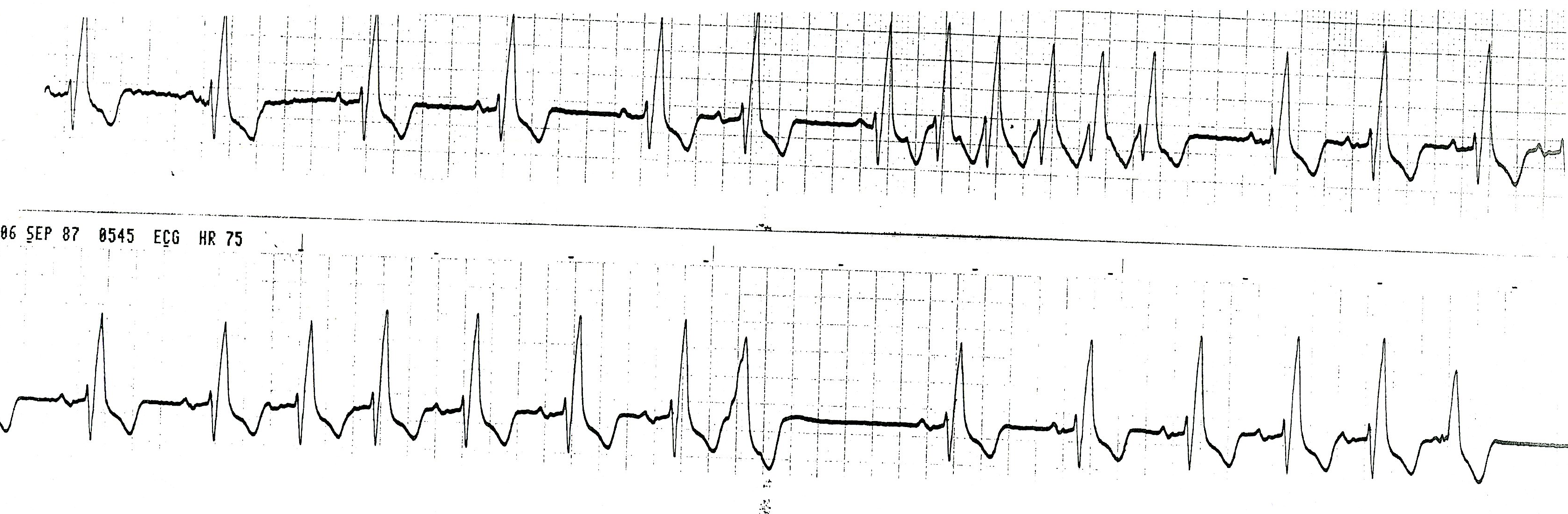 The RBBB persists regardless of the ventricular rate.