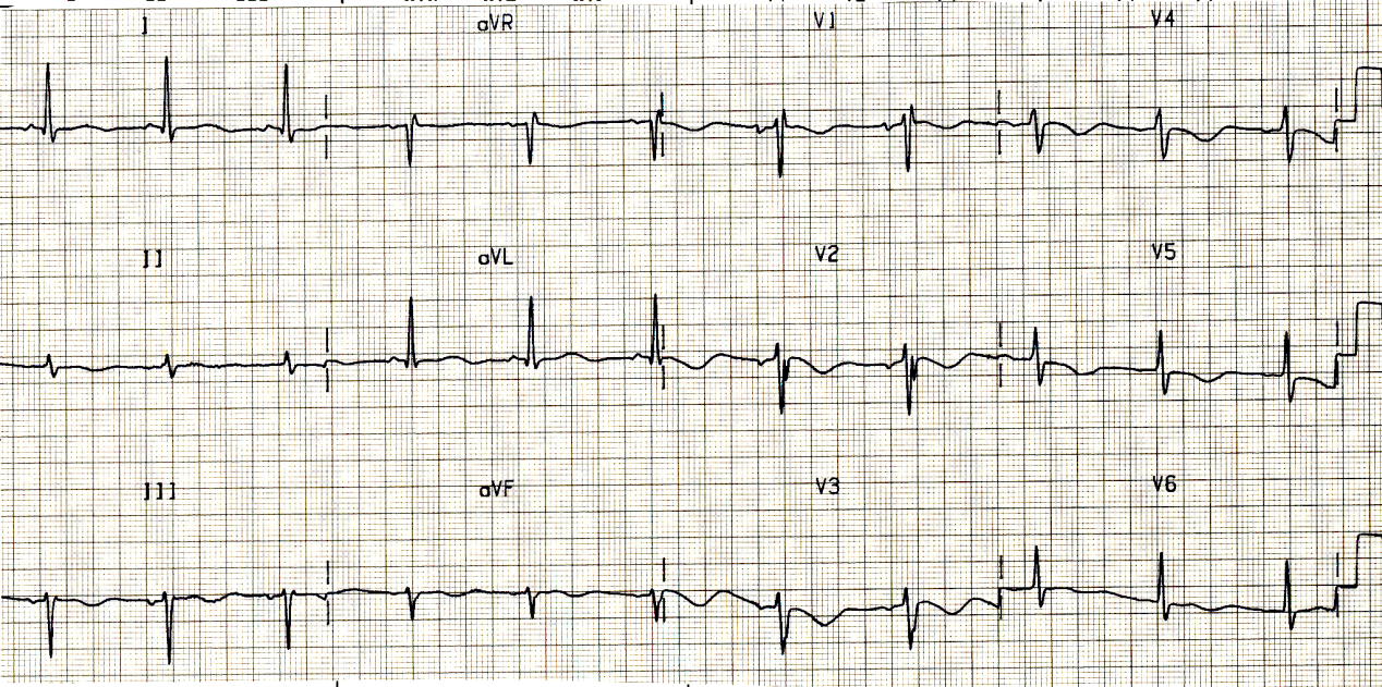 75 year old man two days following emergency repair of bleeding peptic ulcer and truncal vagotomy. There is no clinically apparent heart disease. The changes observed are best explained by (i) his age; (ii) emergency procedure and anÃ¦sthesia; (iii) truncal vagotomy; (iv) sedatives and muscle relaxants?