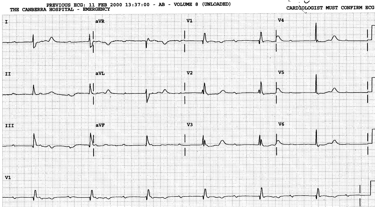 79 year old man with slow pulse.  