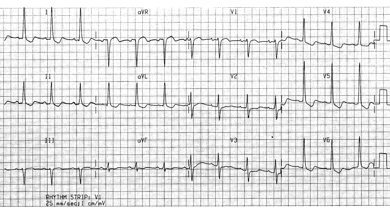 63 year old man transferred from CCU with pulmonary Ådema, clostridial sepsis and malignant pericardial tamponade. Two ECG findings are remarkable by their absence