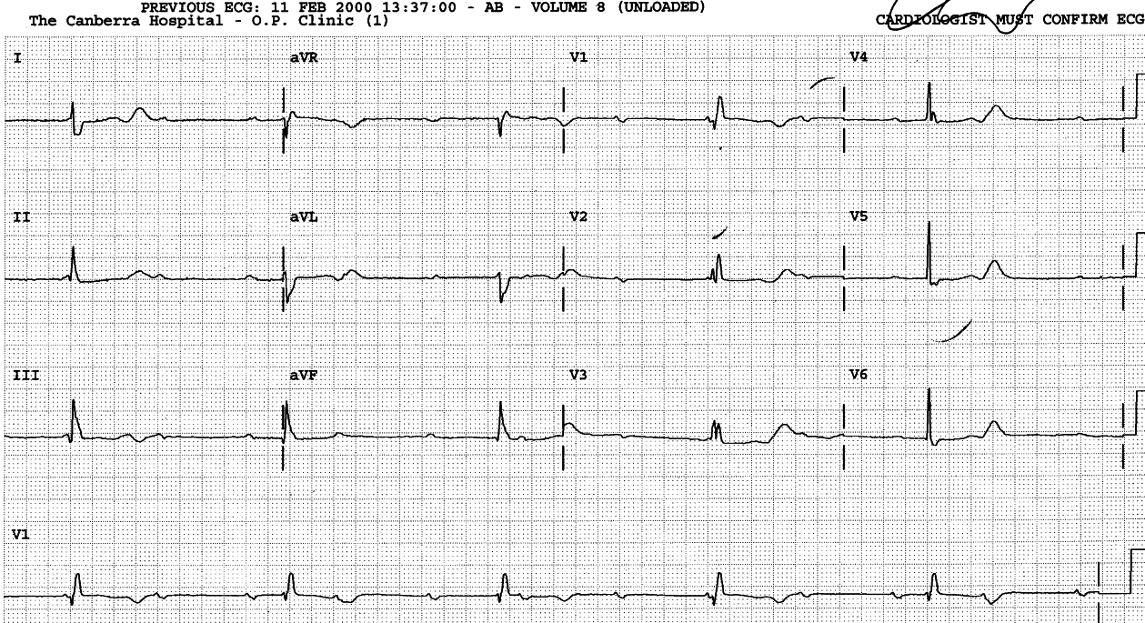 Same patient, day after. It is easier to see that PR intervals     are all different. 