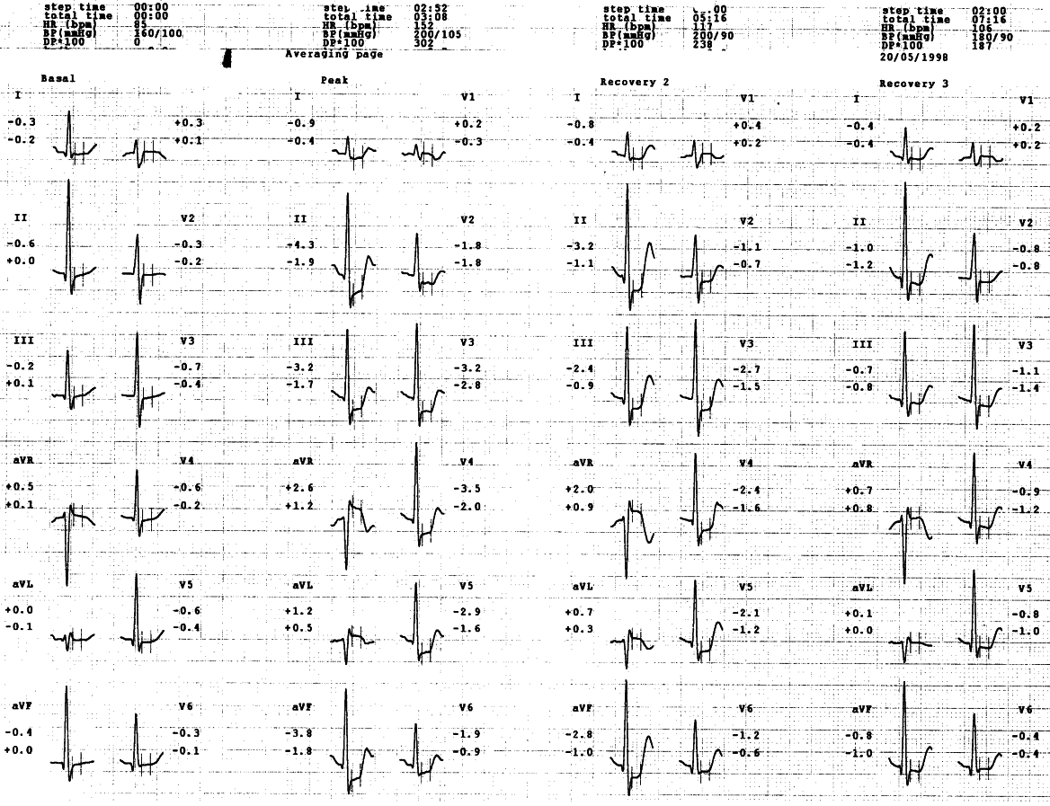 Exercise test of a 53 year old lady with angina of recent onset.