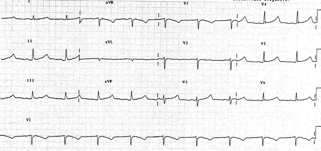 Hypothermic ECG.