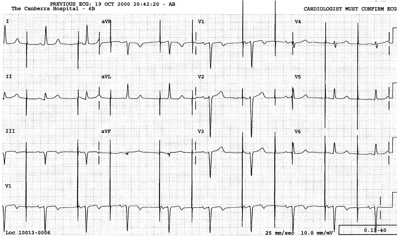 45 year old dialysis patient, in the ward three days after
successful CABGs. The temporary pacemaker is still in situ, set at 70
beats/min.