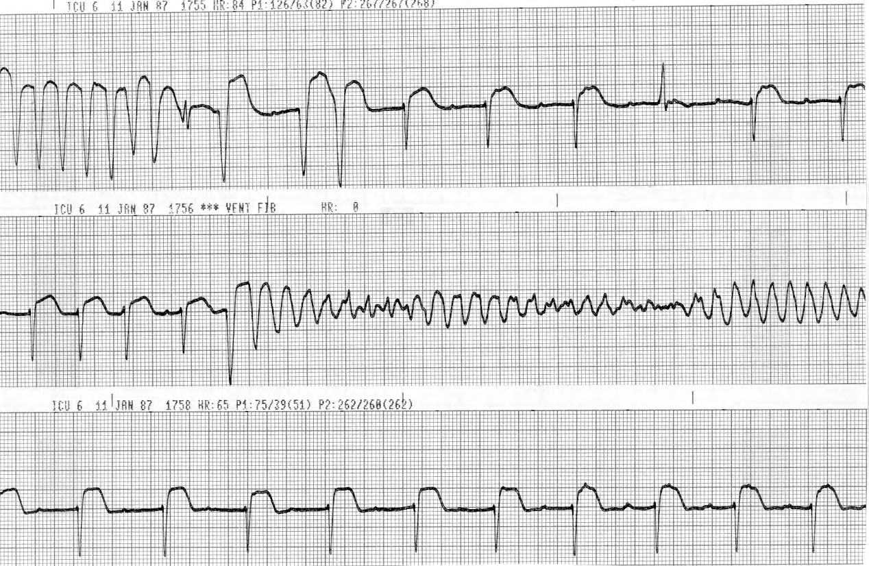 72 year old woman transferred from a peripheral hospital following VF during a silent inferolateral infarction . 