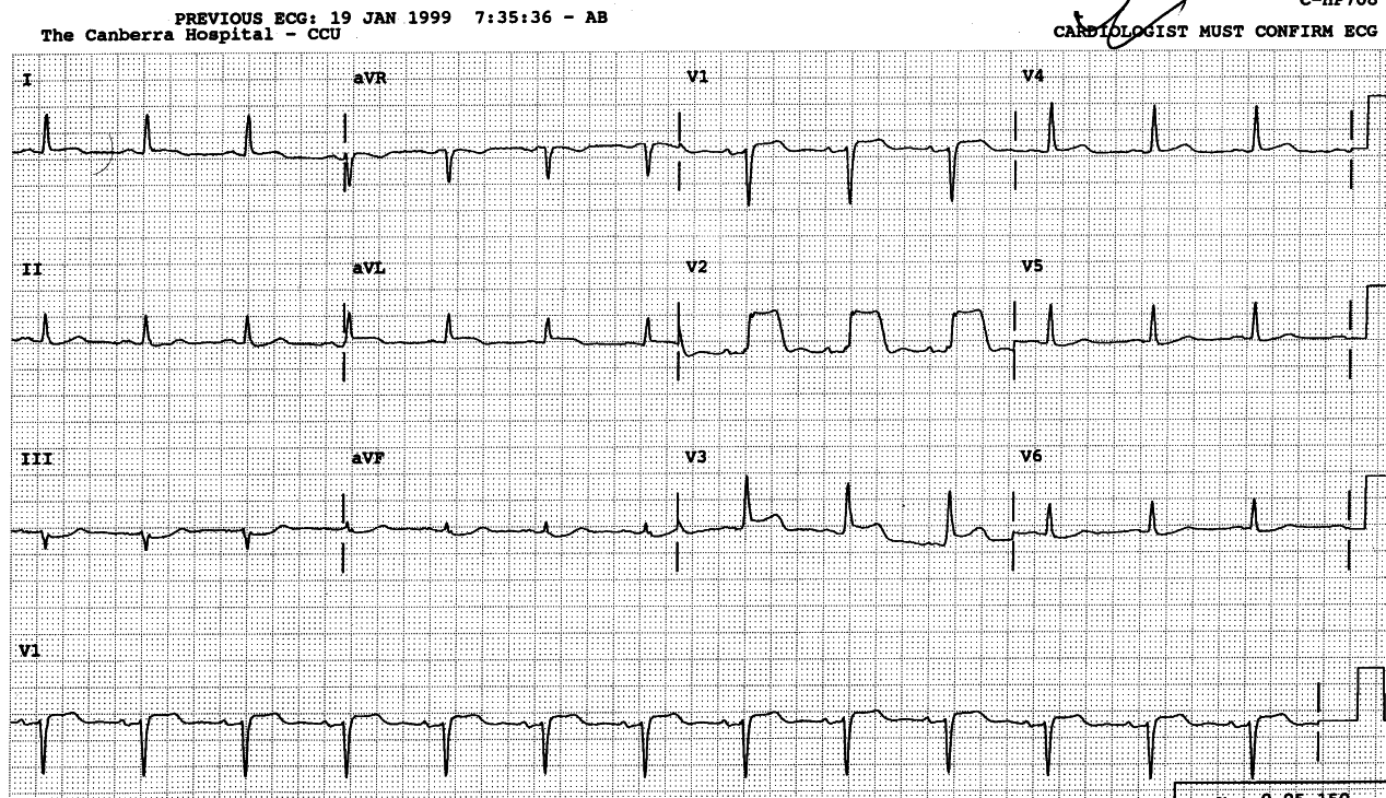 57 year old man in CCU with chest and jaw pain.