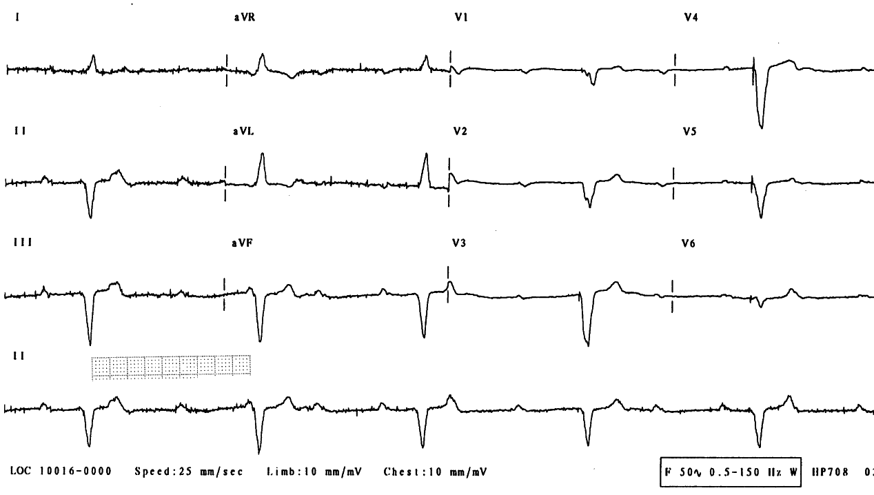 70 year old man admitted because of
bradycardia. A DDD pacemaker had been inserted 7 years previously. There
was no follow-up.