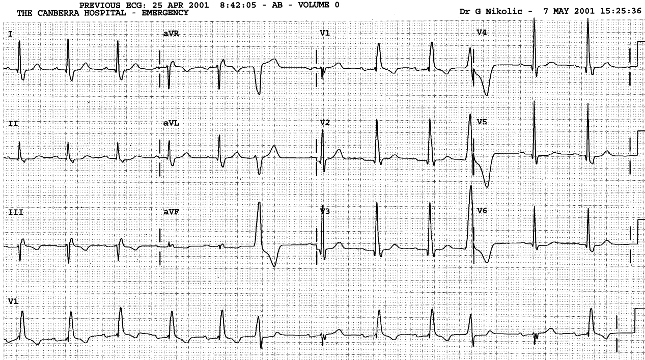 86 year old man in Casualty with fractured humerus. There is no history of heart disease.